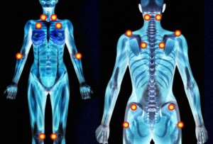 Pain areas common in fibromyalgia patients.